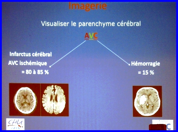 Une conférence sur l'Accident Vasculaire Cérébral (AVC) a été proposée aux visiteurs du Forum des Séniors 