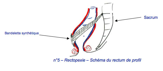 rectopexie