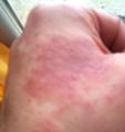 Allergie-Eczéma
