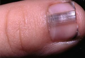 Ongle noir