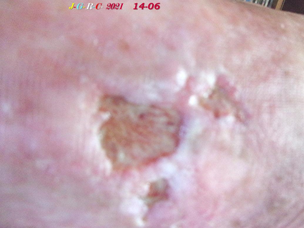 AMES SENSIBLES:  ma jambe en janvier de 2021- 2022  D  20-03-2022