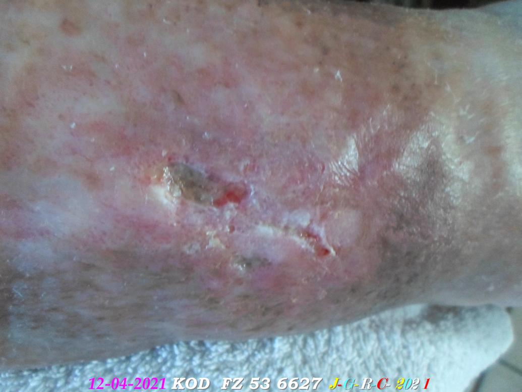 AMES SENSIBLES:  ma jambe en janvier de 2021- 2022  D  20-03-2022