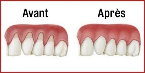 Les Dents.