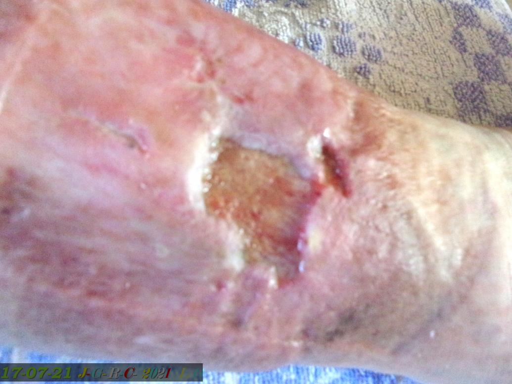 AMES SENSIBLES:  ma jambe en janvier de 2021- 2022  D  20-03-2022