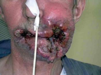 cancer-levre
