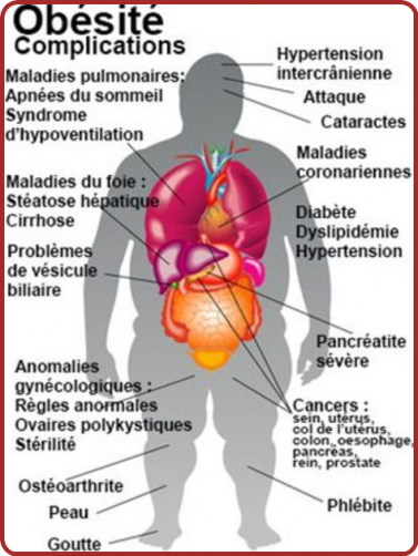 L'Obésité