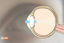La dent du patient est utilisée comme support pour une sorte de lentille en plexiglas.