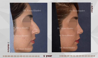 نمونه کار دکتر احسان خدیوی جراح بینی در مشهد 4