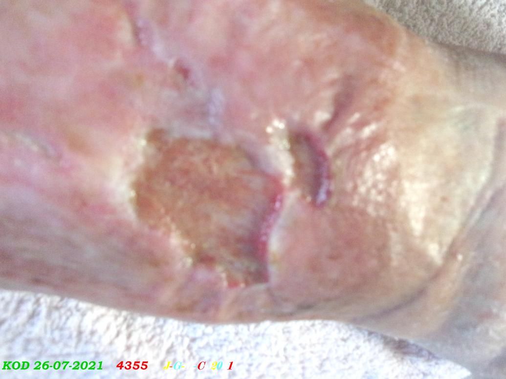 AMES SENSIBLES:  ma jambe de janvier  2021- mars 2022  D  20-03-2022