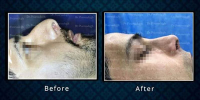 نمونه کار دکتر پور صادق جراح بینی در مشهد 4