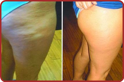 La Cellulite