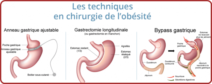 L'Obésité