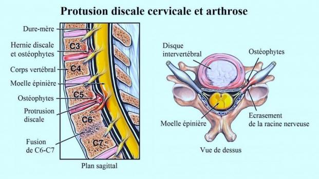Arthrose Cervicale.