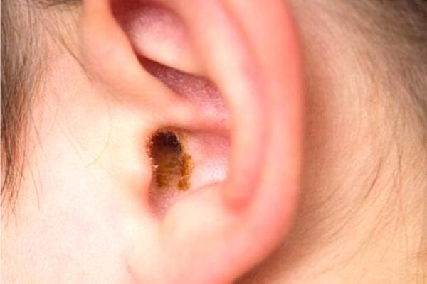 Oreille cérumen