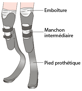 Prothèse de membre inférieur 2 jambes.png
