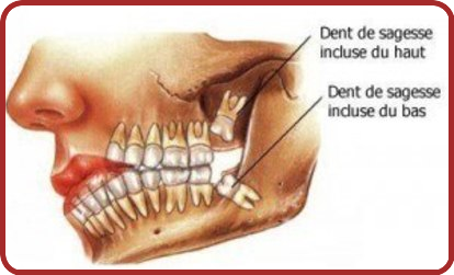 Les Dents