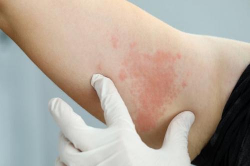 D.lésions urticariennes et maculopapules