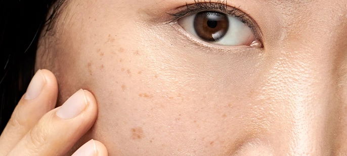 A derm-approved way to get rid of dark spots